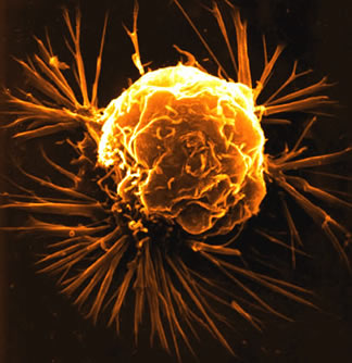 Figure 2. Tumor cells can be targeted using functionalized nanoparticles. The principles of personalized medicine can help to design the nanodrug to be as effective as possible for each patient.