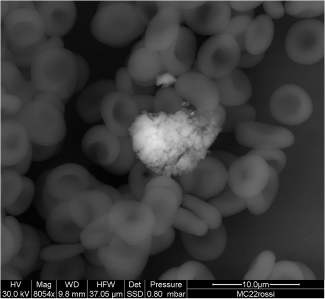 An-vivo image of a cluster of nanoparticles surrounded human red blood cells of a person exposed to pollution.