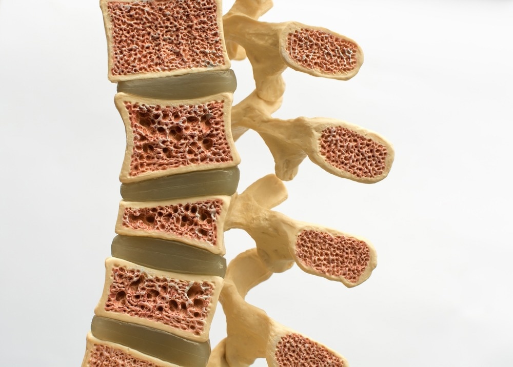 How Can Nanoscience Help to Treat Osteoporosis?