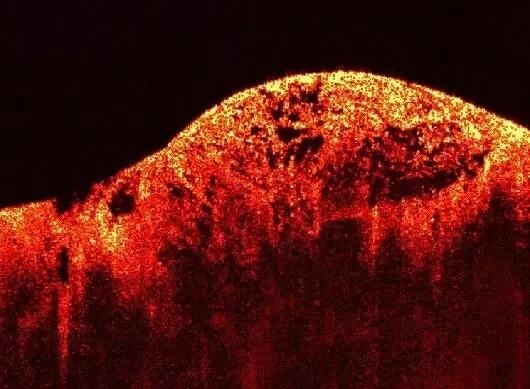 Image of a muscle tumor taken with an imaging system based on Optical Coherence Tomography (OCT)