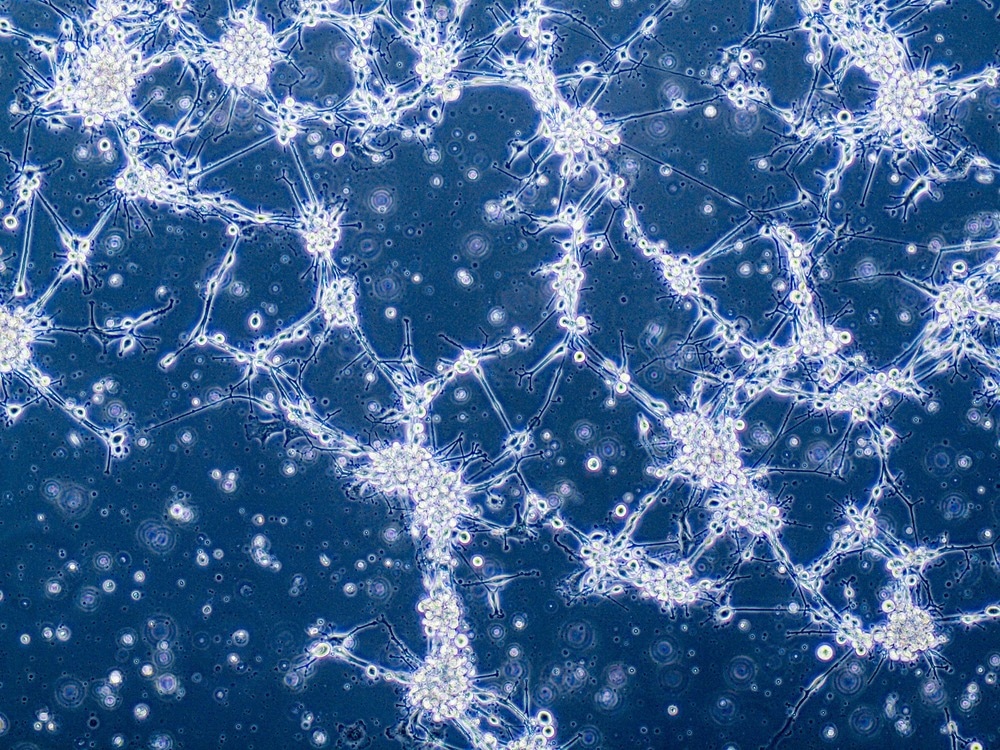 Glioblastoma brain cancer cells under microscope