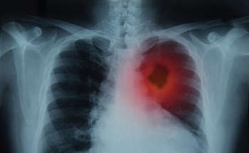 Detecting Lung Cancer Early with Non-Invasive Nanosensors