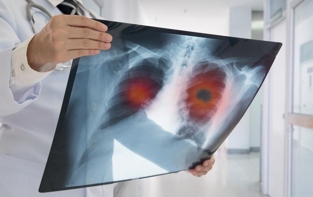 Nanoprobe Designed to Help Combine Lung Cancer Treatments