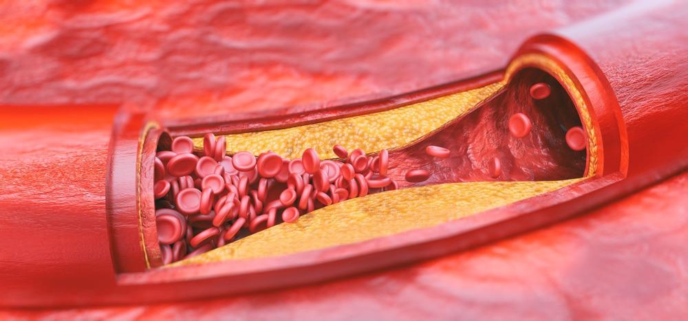 Nanomaterials Highlighted as Key Player in Atherosclerosis Therapeutics