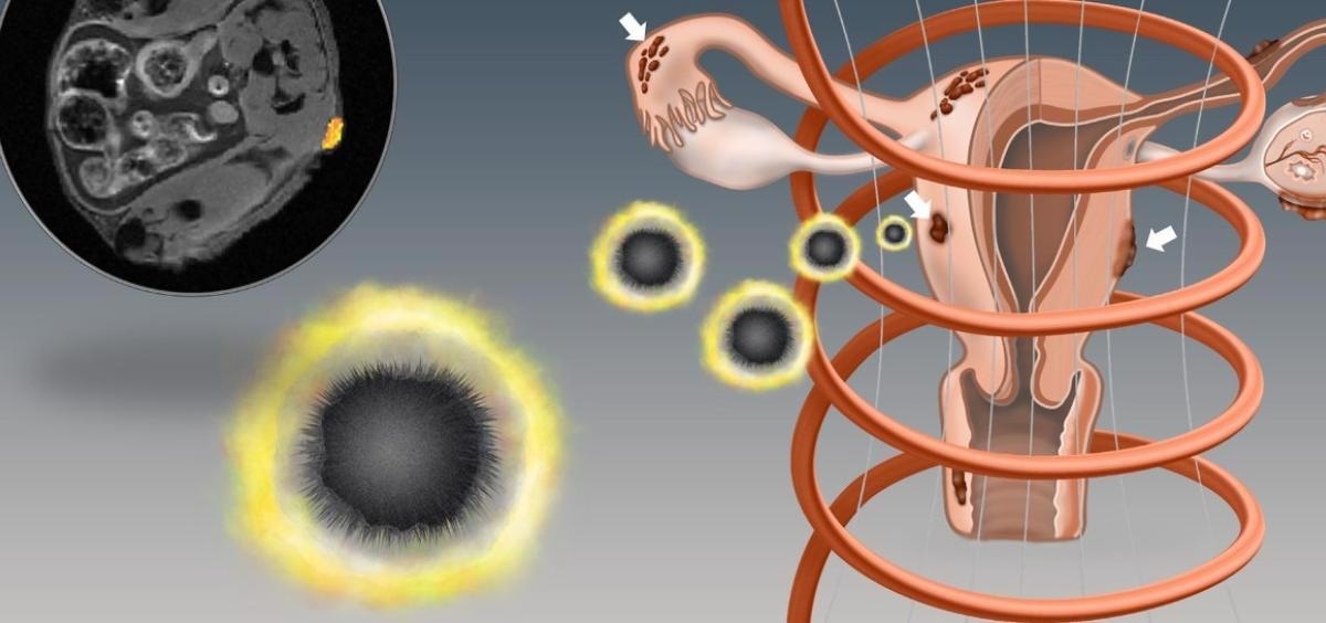 Study Shows Novel Nanoparticles Can Locate and Eradicate Endometriosis Lesions.