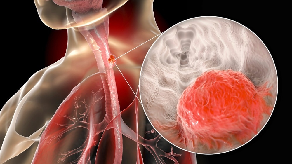 Novel Nanoplatform Found Effective Against Esophageal Cancer