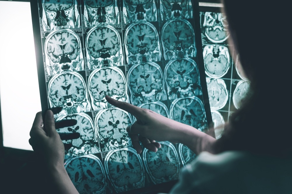A Novel Noninvasive Method for Treating Alzheimer’s Disease