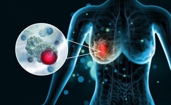 Nanomedicine Specifically Targets Triple-Negative Breast Cancer