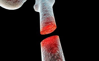 Microgel Encourages Bone Regeneration in Critical-Size Defects