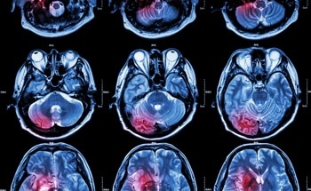 Could Nanoparticles be the Future of Brain Cancer Treatment?