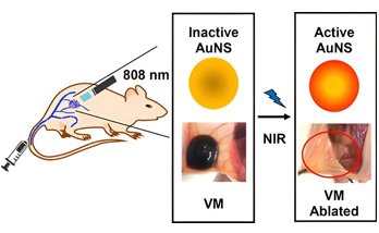 Destroying Venous Malformations by Photothermal Therapy and Gold Nanoshells